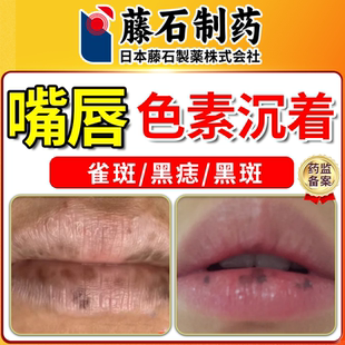 嘴唇黑斑引起黑色素沉淀唇部护理淡化黑色素唇周黑点黑痣去用除CS