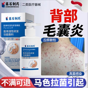 前胸背部长痘痘马色拉菌后背毛囊炎除螨祛痘痒可搭沐浴露专药用LJ