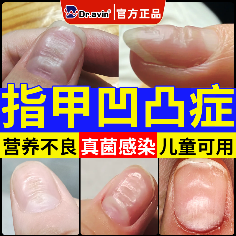 儿童手指甲凹凸不平凹陷凸出变形分层修复液受损再生真菌感染药CS