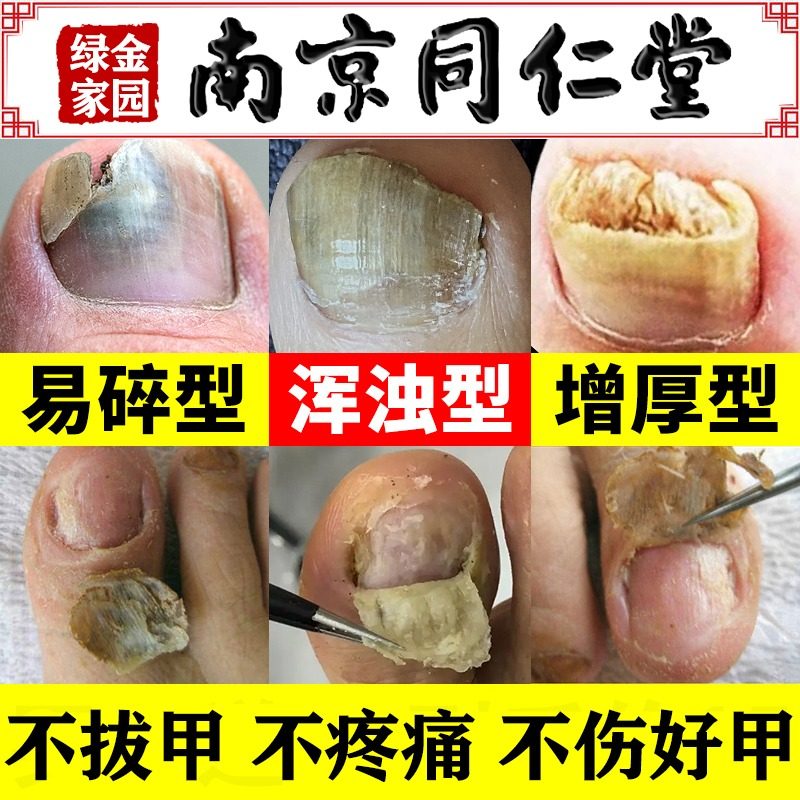 灰指甲甲沟炎甲易生根专用正品真菌王打磨器膏药贴水修脚刀治疗vv