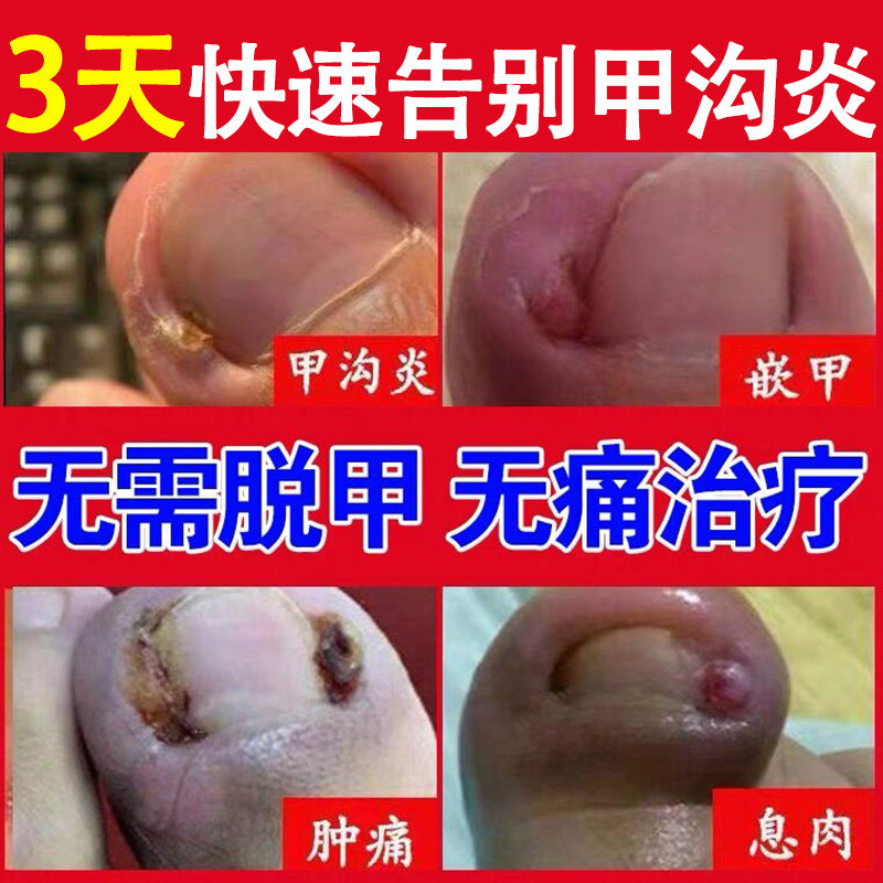 甲沟炎软甲专消肿去肉芽嵌甲矫正用治療手指甲勾药膏软化剂水神器