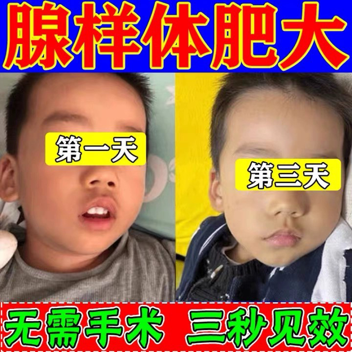腺样体肥大中药贴儿童调理张嘴呼吸呼噜嘴唇上翘扁桃体面容矫正器