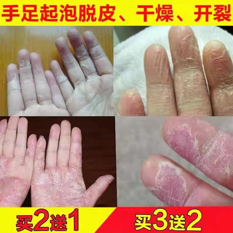 手脚皲裂修复手指头开裂脱皮干裂蜕皮开口子去角质护手足霜愈合膏