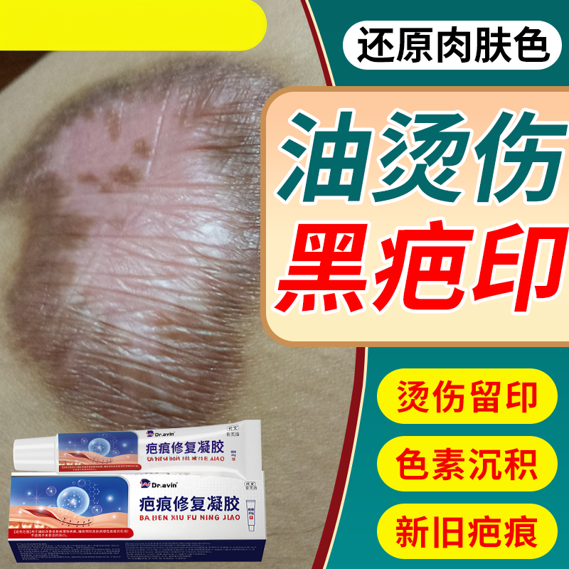 油烫伤去疤膏疤痕修复去黑色素沉淀祛疤除疤膏烧伤淡化黑印色素YS