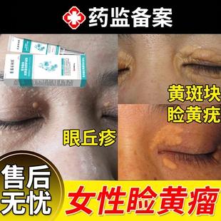 眼睑黄瘤眼部去除黄斑眼脸黄瘤膏眼皮睑黄疣眼贴神器药房同款膏YS