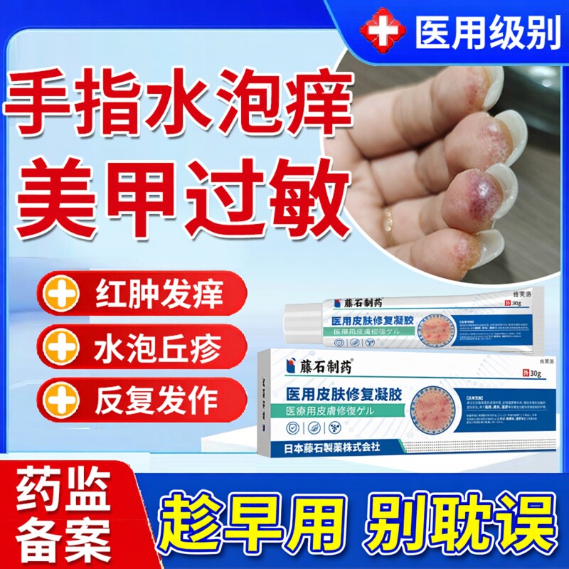 美甲甲油胶过敏手上起小水泡手指头痒指腹发痒红肿干裂脱皮湿疹YM
