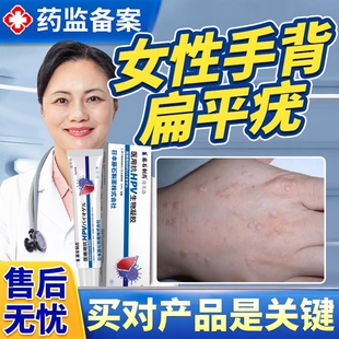 手背扁平疣去除膏一抹灵偏平疣医用软膏专用去尤瘊药房同款膏根YS