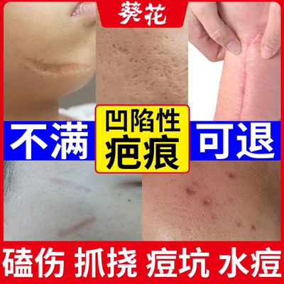 【葵花疤痕凝胶】专注凹陷性疤痕