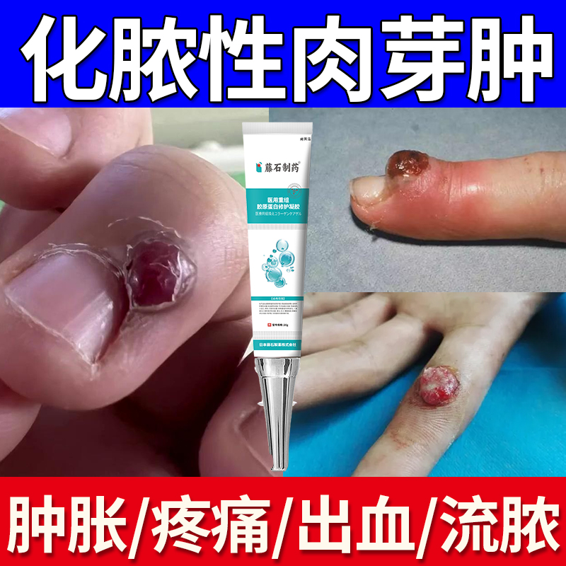 化脓性肉芽肿手指肿胀疼痛溃烂流出血鼓包红色丘疹药监备案软膏YM