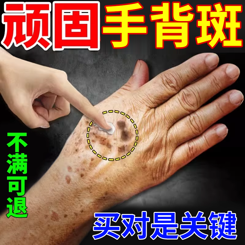 【现货速发】老人斑老年斑膏