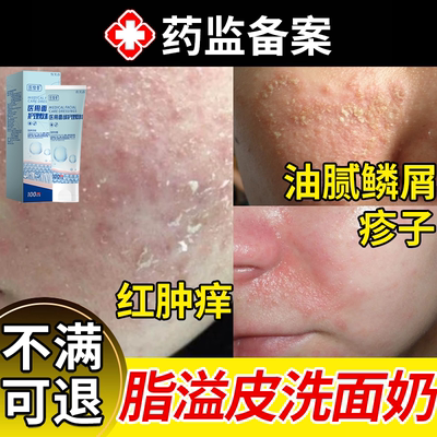 【现货速发】脂溢性皮炎修复屏障