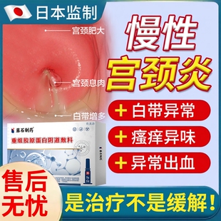 慢性宫颈炎专用炎症炎康栓剂妇科凝胶药房宫颈纳氏囊肿息肉肥大YS