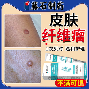皮肤纤维瘤膏去除软膏硬块非脂肪瘤膏贴神器皮下硬疙瘩YS