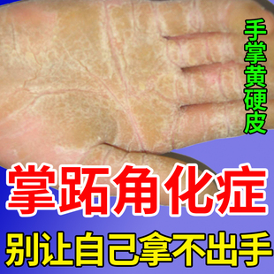 掌跖角化症掌趾手掌心发黄增厚硬皮角化型湿疹专用膏脱皮干裂YM