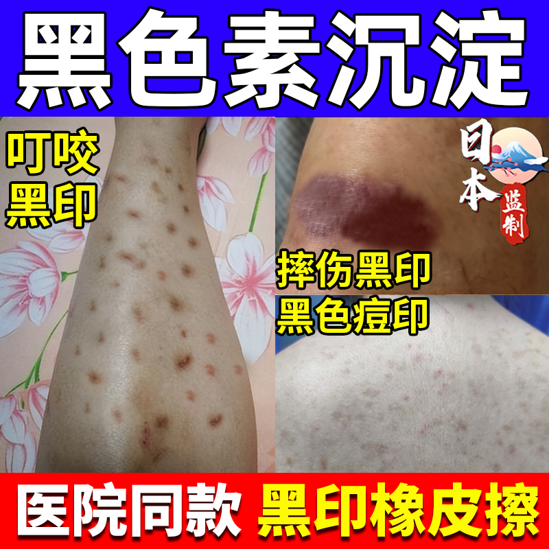 黑色素沉淀蚊虫叮咬印痘印疤印