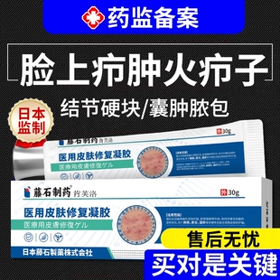 脸上疖肿火疖子红肿结节硬块痘痘皮脂腺囊肿拔毒拔脓膏非敷料贴YS