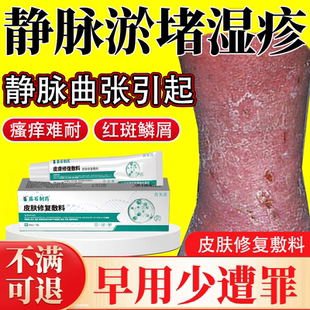 静脉曲张皮肤痒静脉炎老烂腿专用敷贴淤积性皮炎湿疹药房同款膏YY