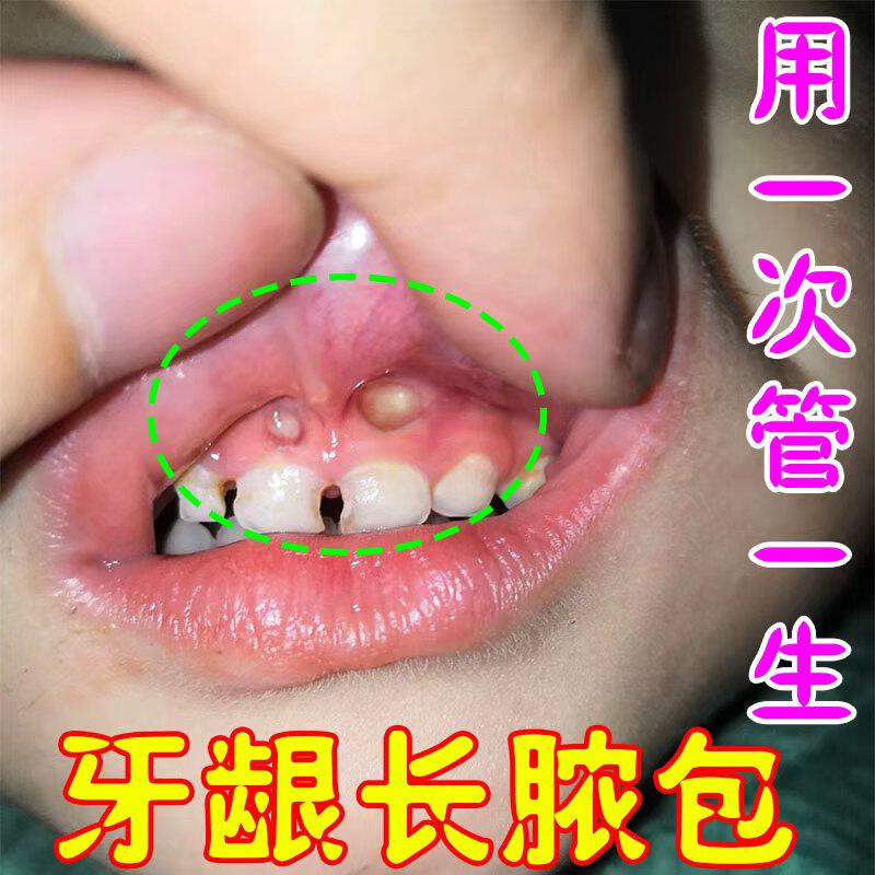 牙龈脓包肿痛牙周炎牙龈息肉增生上火智齿红肿出血牙髓跟疼用喷剂