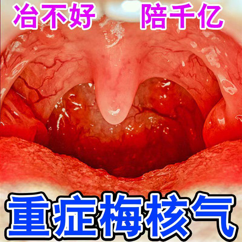 梅核气慢性咽炎卡痰咽喉有异物嗓子干痒喉咙老有痰吐不完咳嗽专用