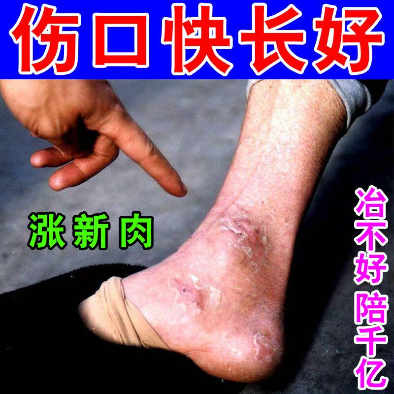老烂腿長新肉烂足伤口愈合促进长肉结痂老烂腿烂脚伤口流水流脓膏