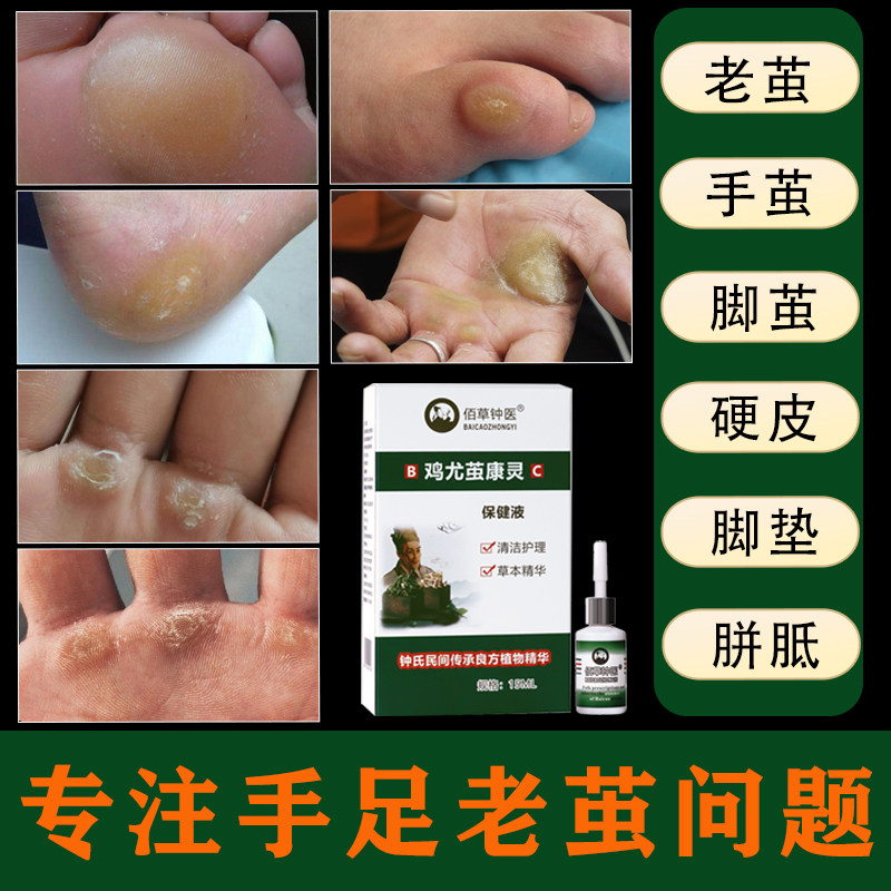 去老茧脚茧关节茧胼胝