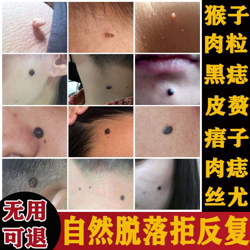 去痣神器无痕正品点痣水祛痣膏去肉粒瘊痦子红痣去丝状扁平尤外用