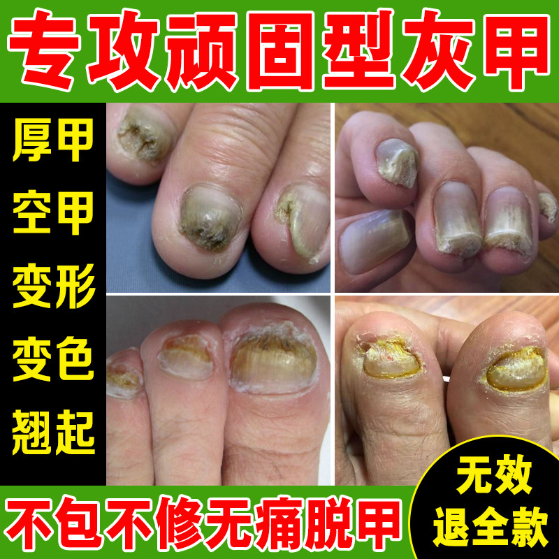 灰指甲脱甲精油去除增厚甲分层变色萎缩凹凸甲廯灰指甲正品旗舰店