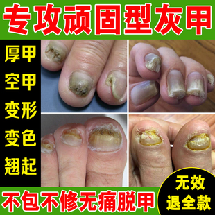 灰指甲脱甲精油去除增厚甲分层变色萎缩凹凸甲灰指甲正品 旗舰店