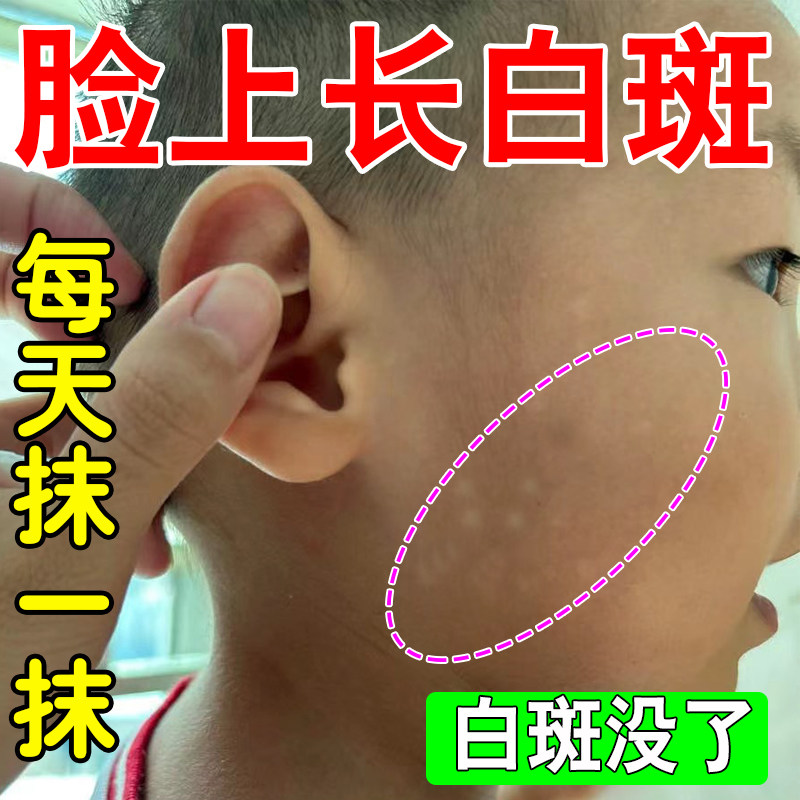 白色糠疹药膏儿童脸上长白斑小孩汗斑皮肤瘙桃花癣皮肤瘙痒药膏