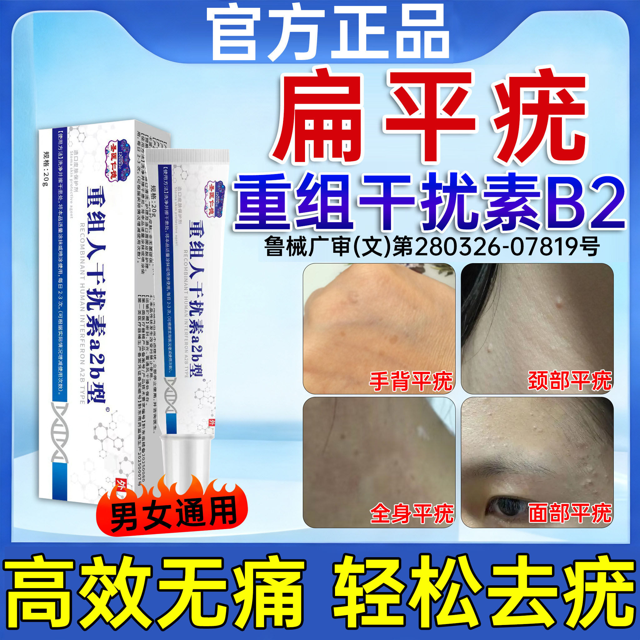 hpv重组人干扰素b2凝胶扁平疣专I用疣体脱落膏去疣瘊官方旗舰店JN