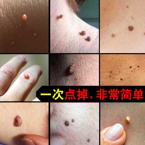 消除肉丁丁消小肉粒药膏去除神器身上脖子上长小肉粒