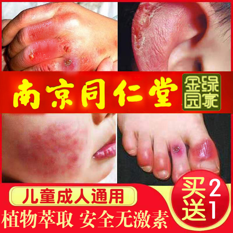 冻疮膏止痒冻伤膏消肿手部防冻防裂护手霜治冻脚部儿童脸部耳朵根