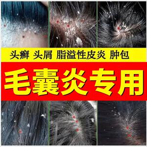 毛囊炎专用药膏水去头皮屑头皮头部控油止痒毛炎宁洗发水官方正品