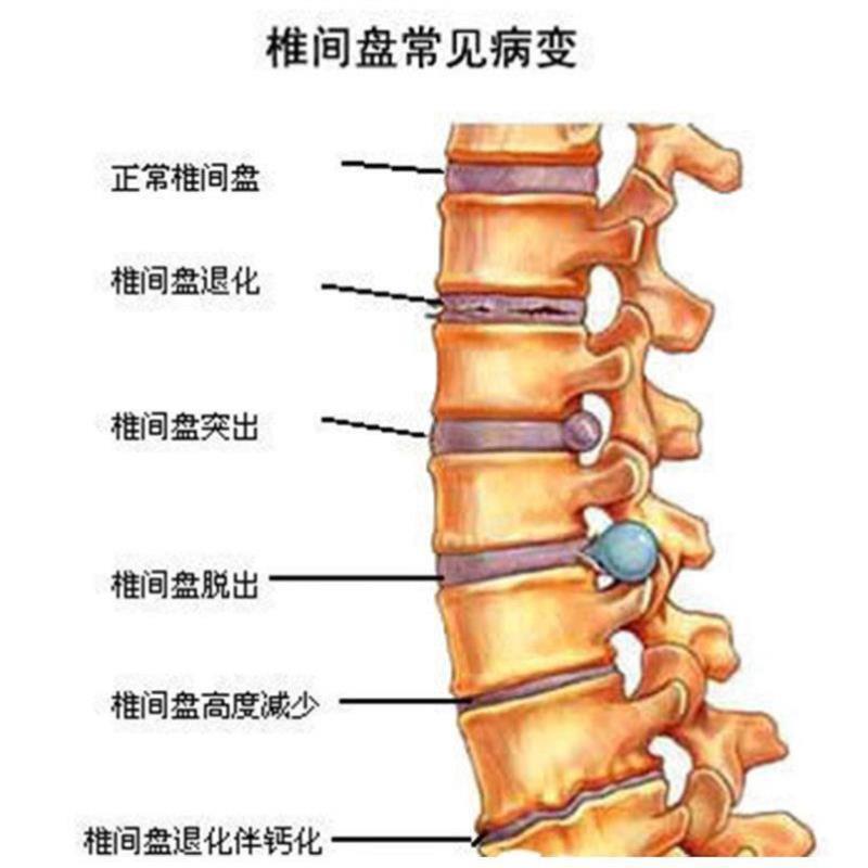 【试用1盒】腰间盘突出膏贴腰椎贴坐骨神经疼腰痛专用