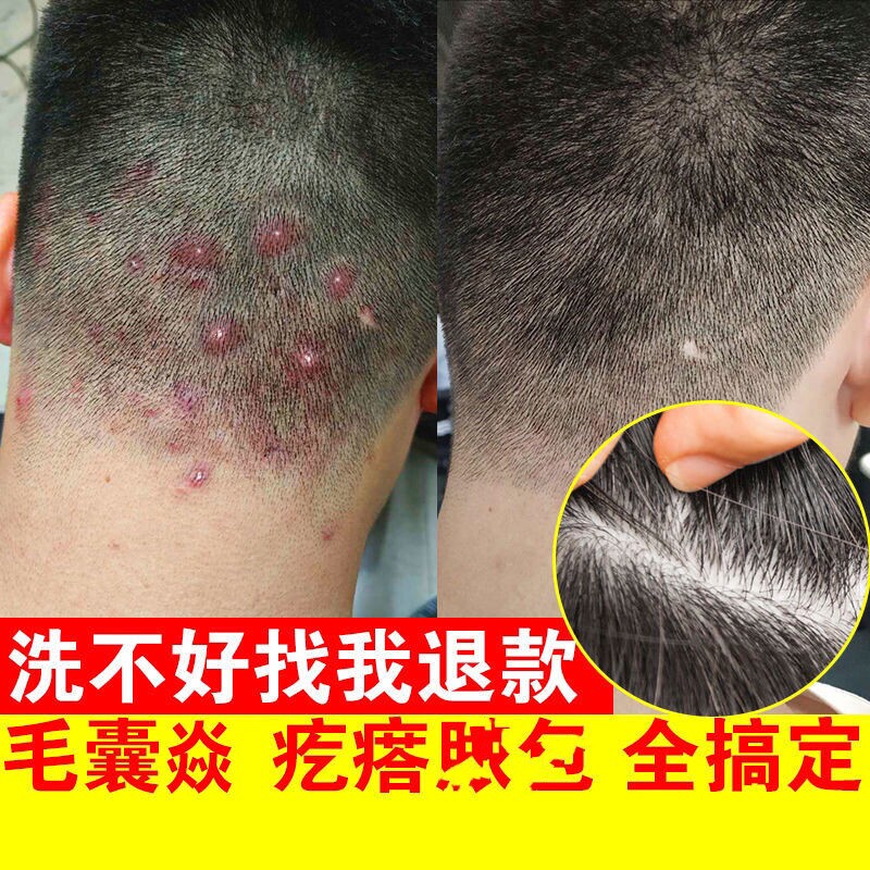 头上长红疙瘩头皮长痘痘痒头皮屑多去头屑洗发水治毛囊发炎专用药