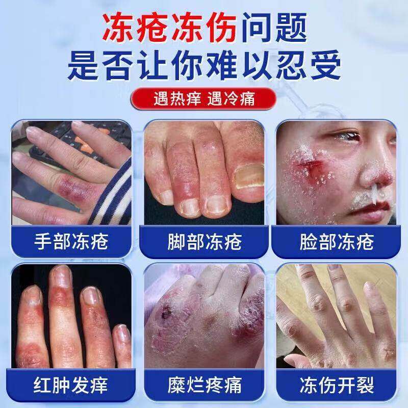 香港大药房正品冻疮膏手脚干裂耳朵红肿冻伤脸部消肿止痒膏yb5