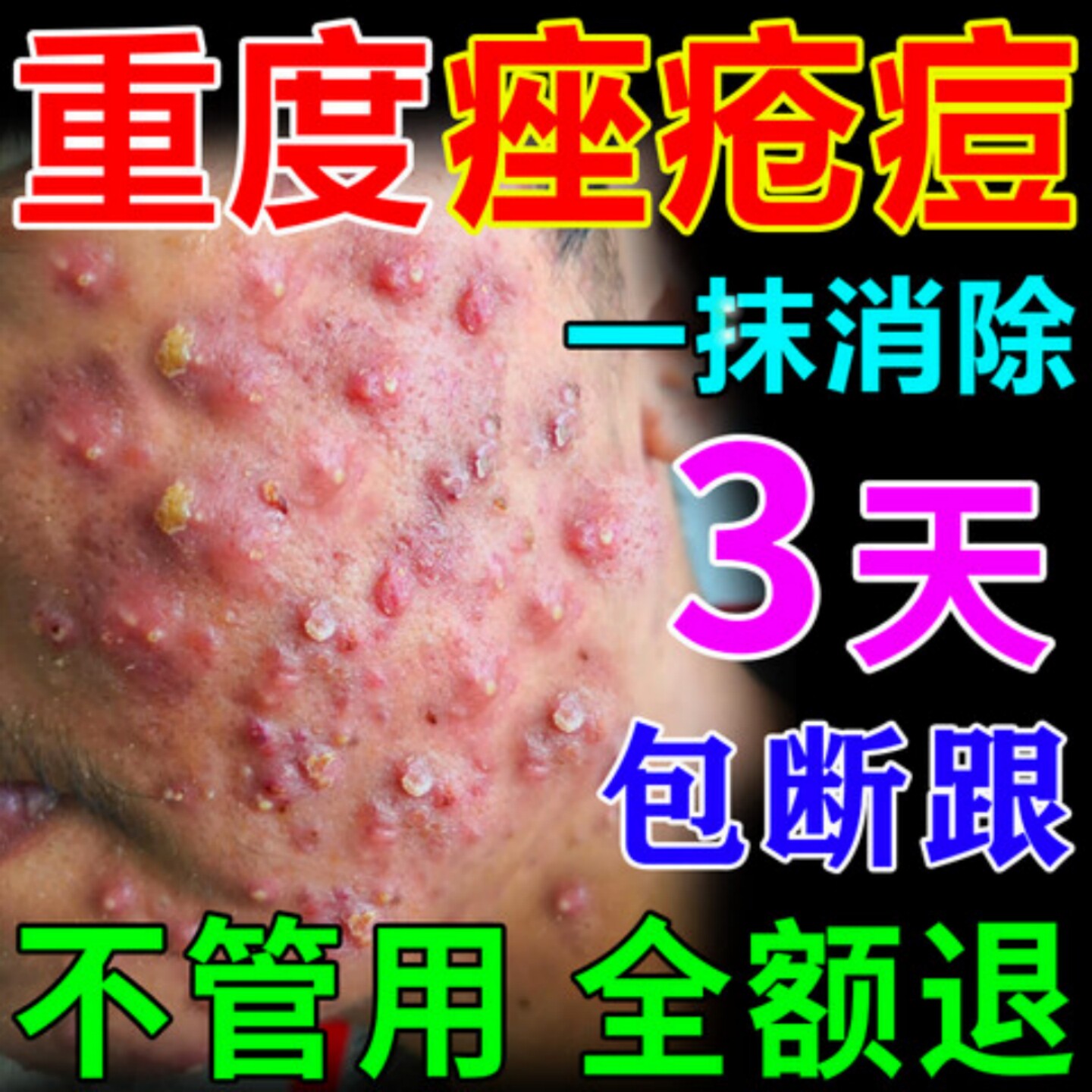 祛痘痘印痘坑青春修复药膏脸部淡化炎消去闭口粉刺红肿痤疮凝胶