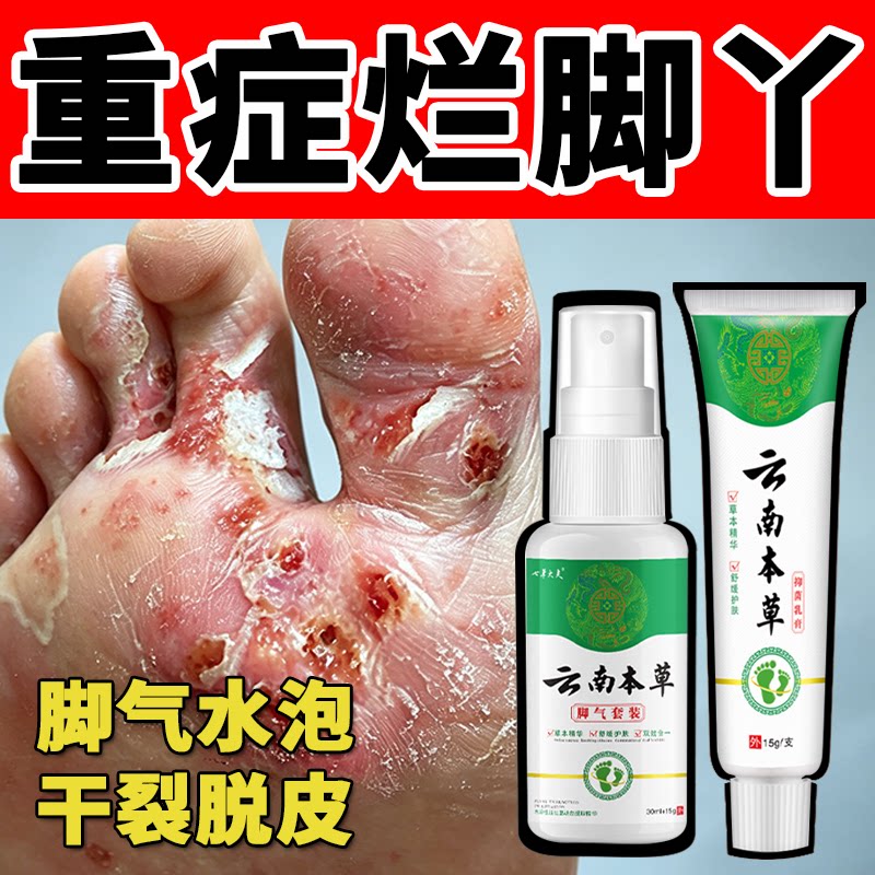 脱皮真菌感染脚气脚痒糜烂脚趾水泡型臭脚止汗止痒脱皮杀菌止痒膏