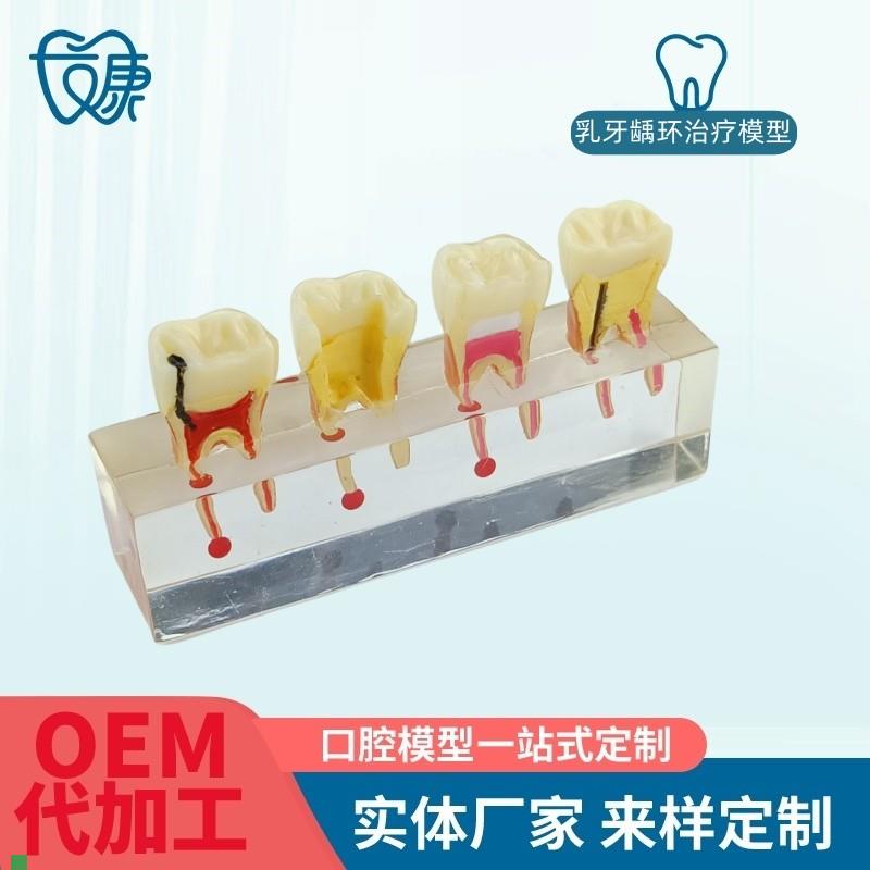 根管牙髓治疗模型牙科口腔教学牙模种植修复病理模型医Z患沟通模