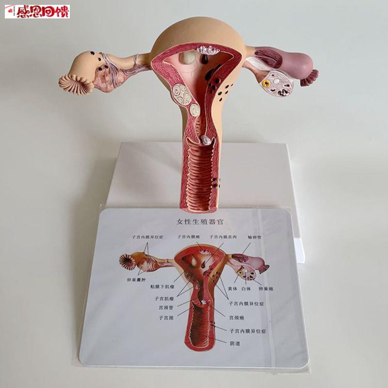 病理子宫模型女生殖肌层输卵管卵巢妇科k常见病理医药促销跨境热