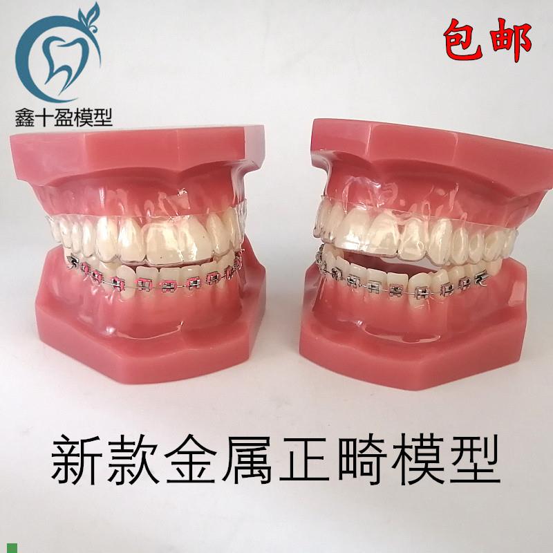 牙科口腔教学模型隐o形正畸矫正模型金属正畸模型口腔展示模型