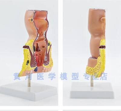 大号人体直肠i模型结肠病理直肠痔疮直肠常见病模型直肠和肛管模