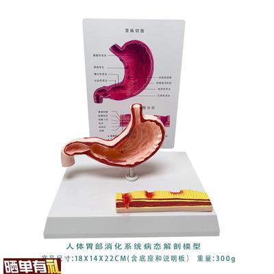 胃病态结构模型萎l缩胃炎溃疡穿孔人体消化系统模型人体解剖教具