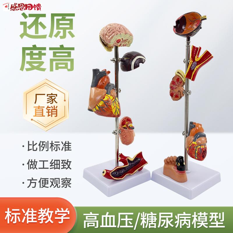 高/血压模型 糖尿/病变内脏k模型病态血压 病理脑 眼心脏肾脏血