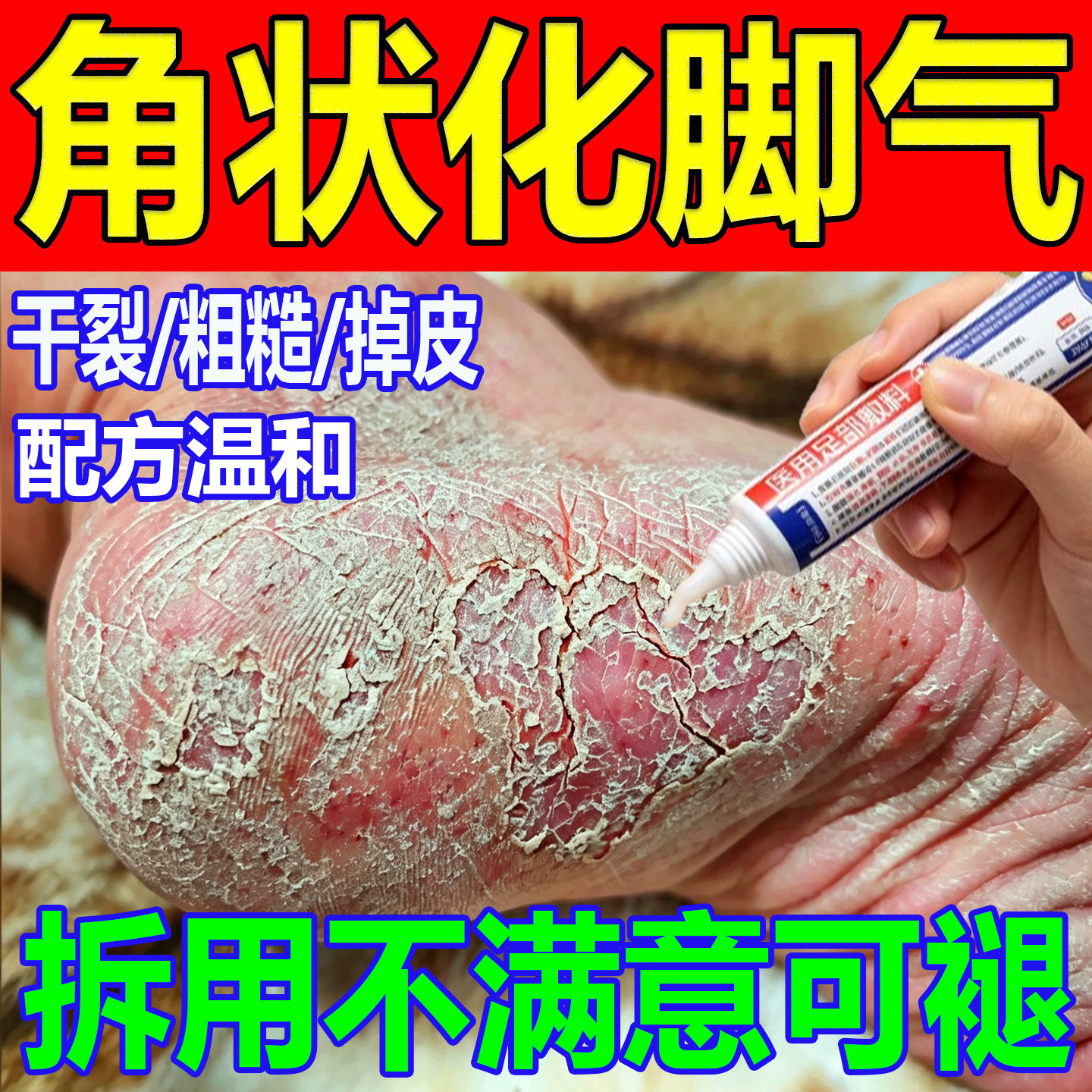 角化型脚气脚后跟干裂真鳞屑菌感染痒瘙增厚臭去死皮足藓质药专用