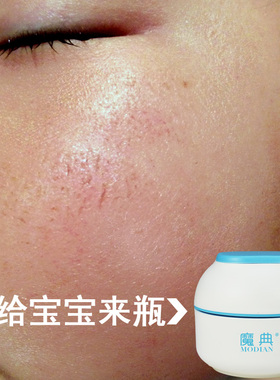 儿童小孩婴儿小童脸干燥缺水爆皮干裂脱皮起皮泛红防皴掉皮退皮屑