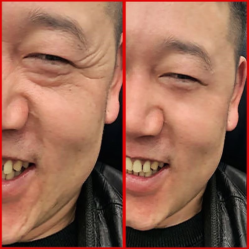 祛除淡化眼霜神器去皱纹抗衰老