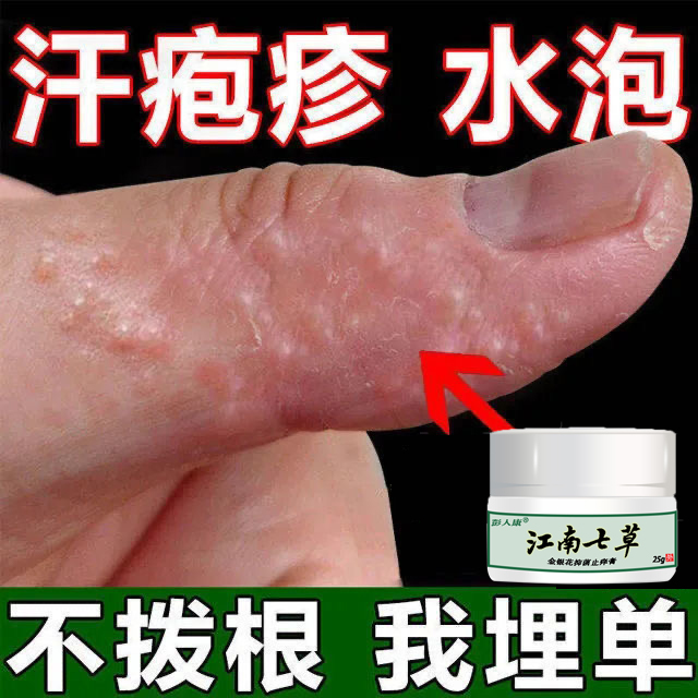 汗疱疹手癣膏手足藓真菌感染脱皮干裂水泡手气鹅掌风