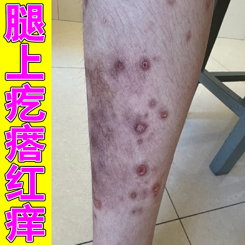 腿上长顽固硬疙瘩全身皮肤干痒粗糙外用草本修护软膏腿上长硬疙瘩