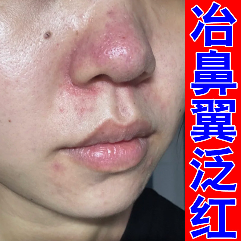 鼻翼两侧红肿发痒皮肤感染过敏干燥粗糙专用草本软膏鼻子泛红发痒
